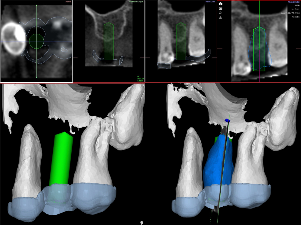 Clinica Abella Ribas - Tratamientos - Autotransplante II