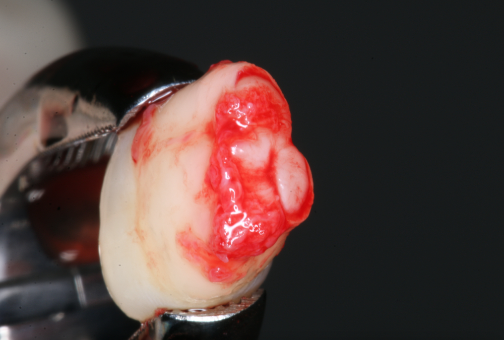 Clinica Abella Ribas - Tratamientos - Autotransplante