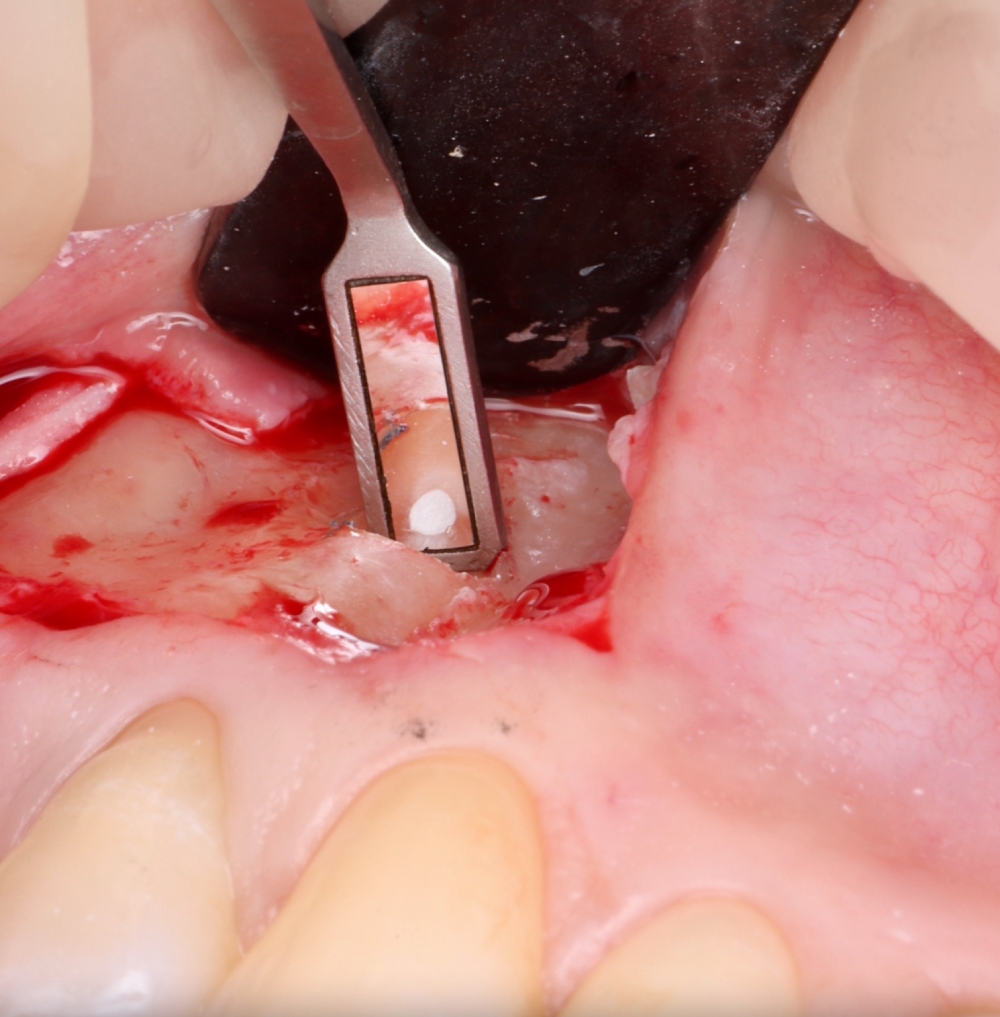 Clinica Abella Ribas - Tratamientos - Cirugía Apical