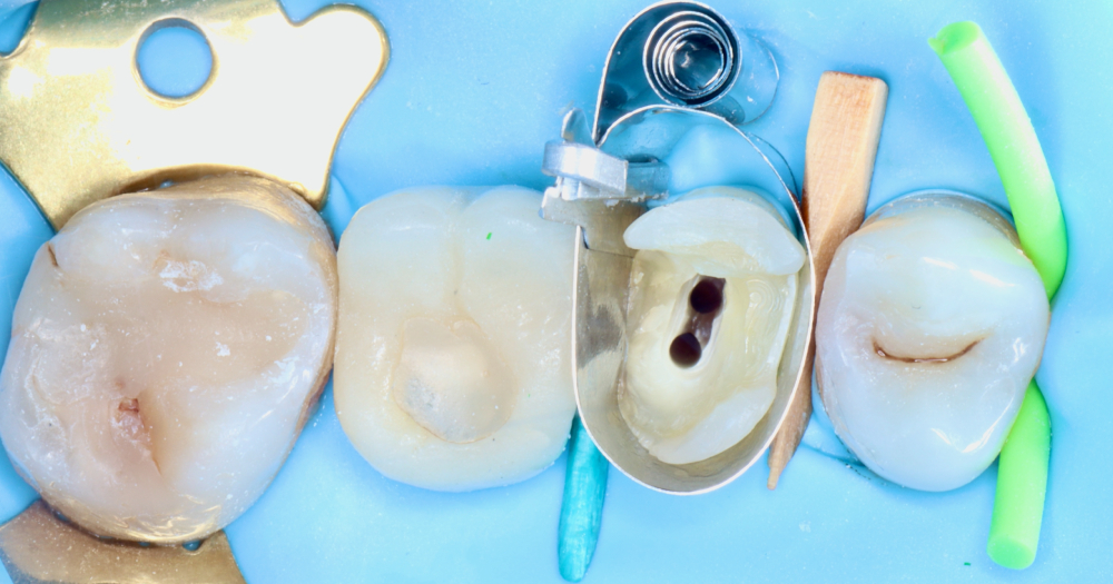 Clinica Abella Ribas - Tratamientos - Endodoncia Microscópica