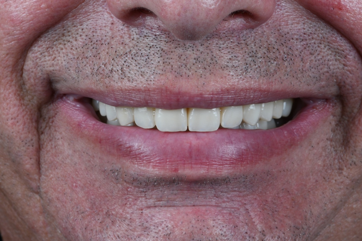 Clinica Abella Ribas - Tratamientos - Estética Dental