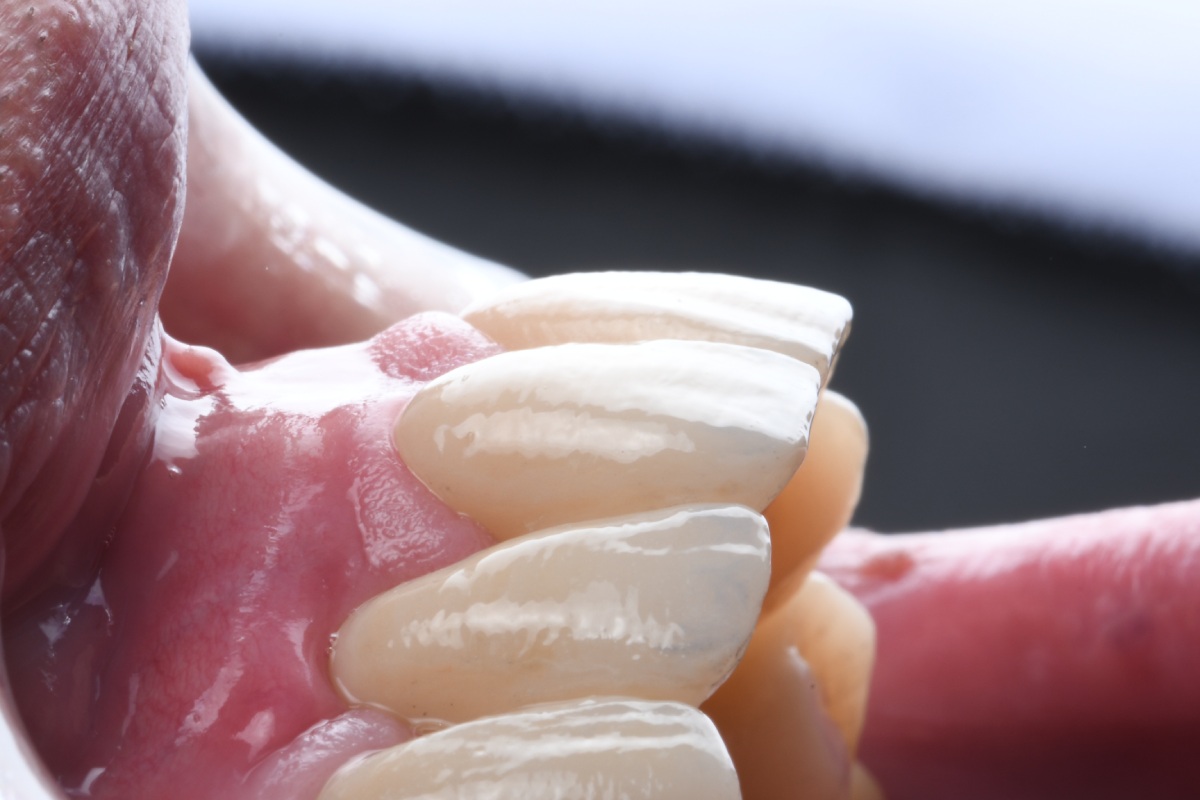 Clinica Abella Ribas - Tratamientos - Estética Dental