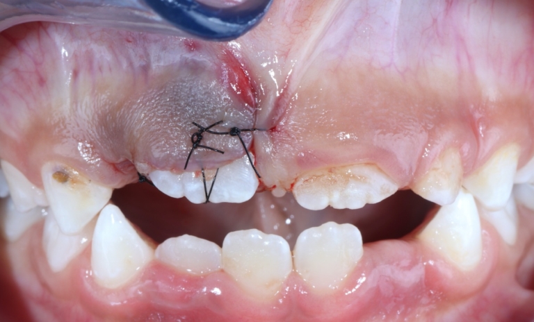 Clinica Abella Ribas - Tratamientos - Traumatismos Dentales