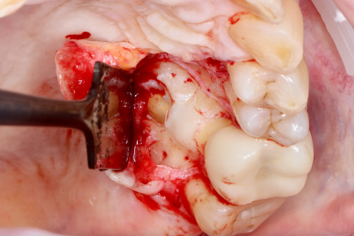 Clinica Abella Ribas - Tratamientos - Cirugía Apical
